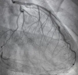 Angiography