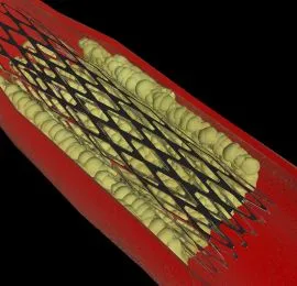 CTO Angioplasty